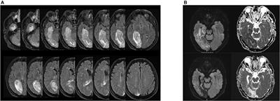 Case report: “Proust phenomenon” after right posterior cerebral artery occlusion